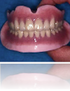 治療用義歯